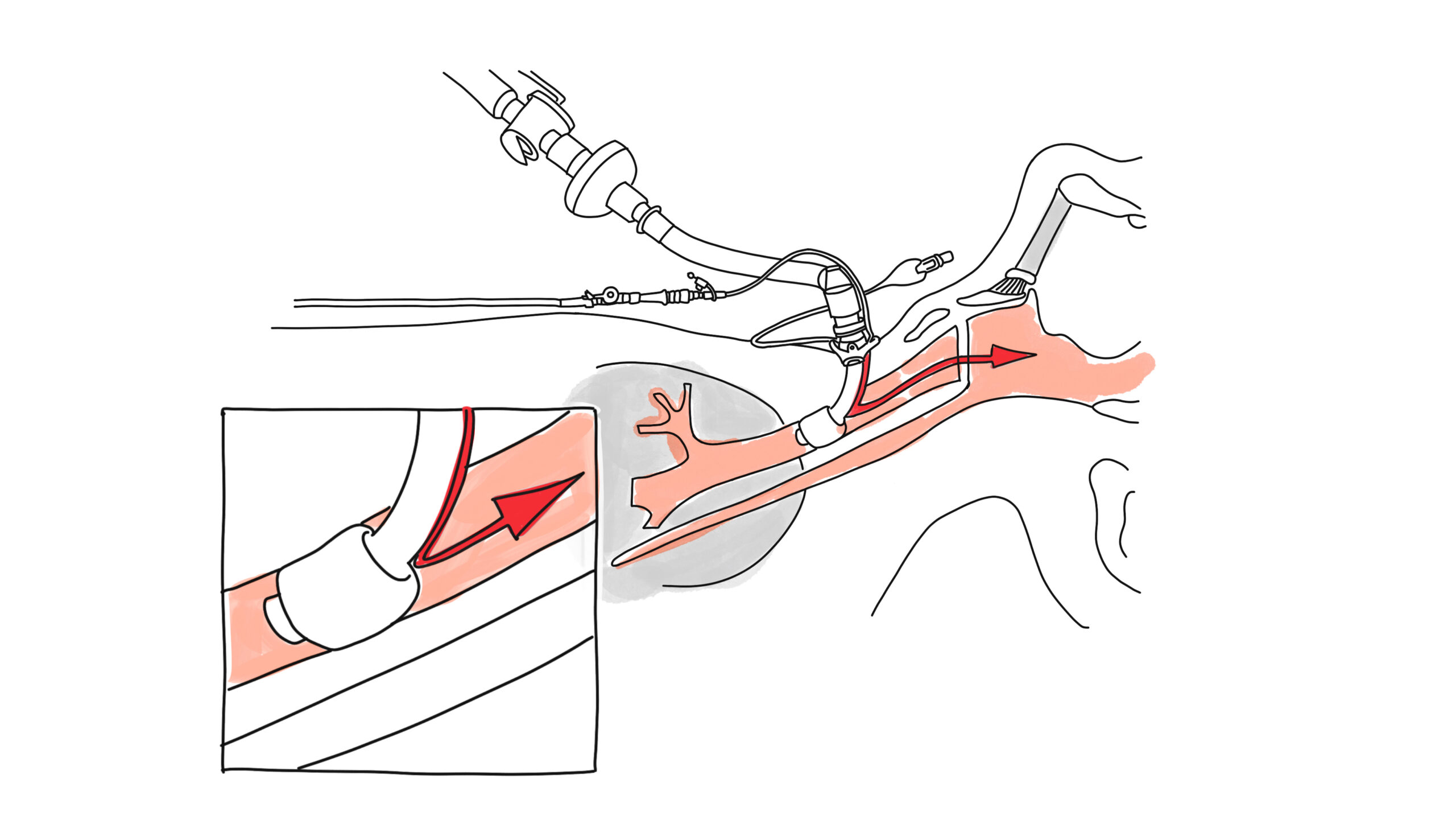 tracheostomy tube illustration